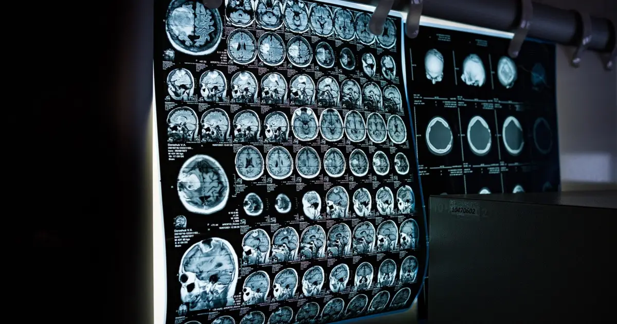 i3S replica tumores cerebrais pediátricos para novas terapias